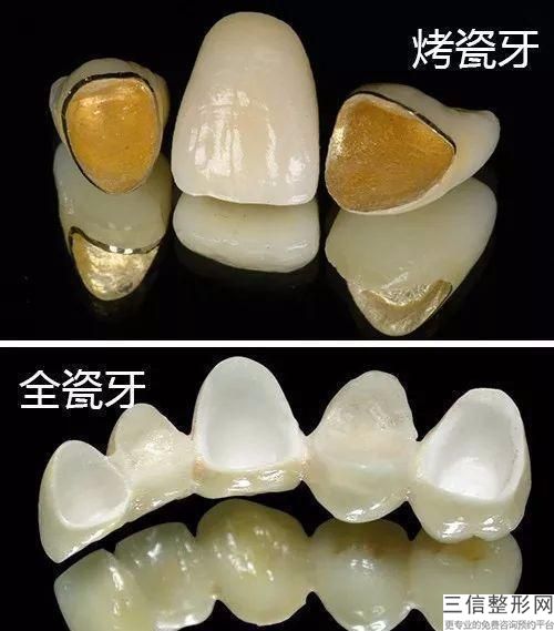 杭州做個烤瓷牙多少錢？牙的材料不同價格