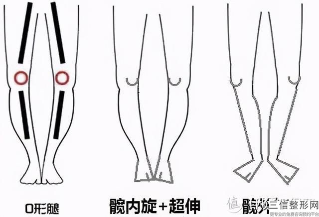 眶隔脂肪釋放一般多少錢(眶隔脂肪釋放大概價(jià)格參考表)