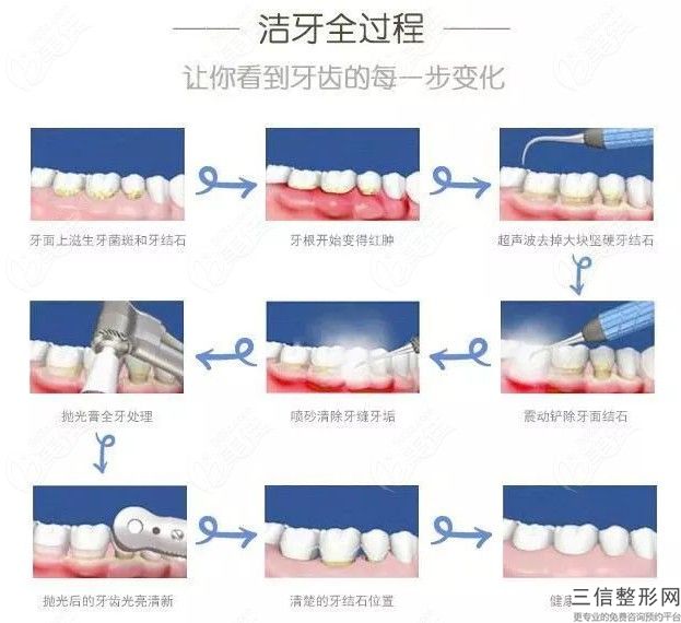 下頜角的矯正方法有哪些？怎么矯正牙齒呢？