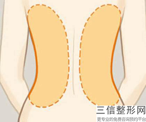 做腹部吸脂危險嗎？怎么破？腹部的危害