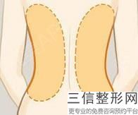 做激光吸脂和瘦腿安全嗎？大腿吸脂術(shù)后的護(hù)理