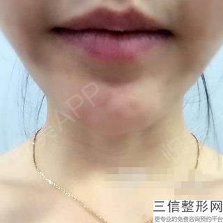 如何修復(fù)玻尿酸注射后的微笑唇？這是每個人都關(guān)心的問題