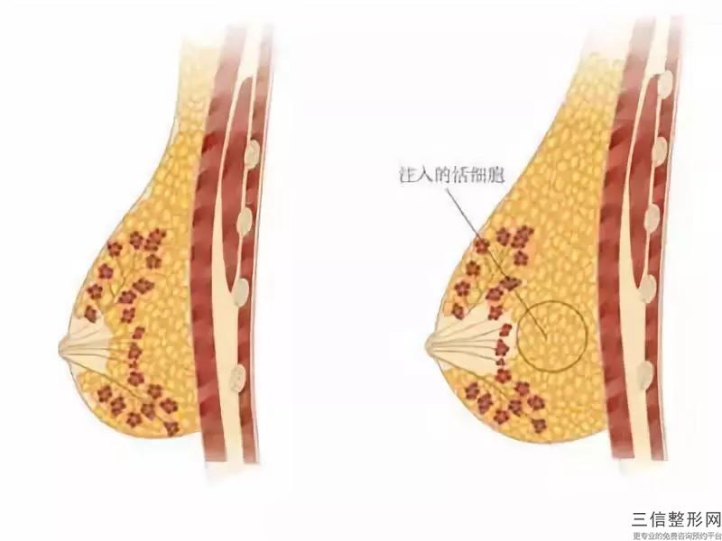 12月做自體脂肪隆胸需要注意些什么？！！