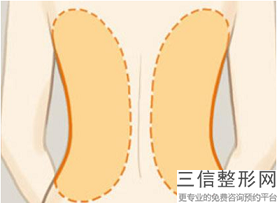 大連抽脂瘦腿的費用是多少？吸脂術的注意事項