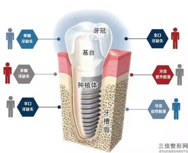 合肥的透明正畸手術(shù)多少錢？隱形矯正的有效治療方法