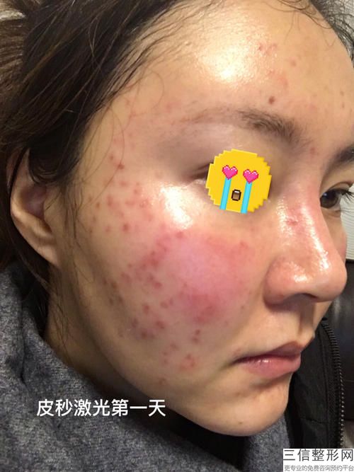 妊娠紋激光手術后如何恢復？激光治療后效果相當不錯