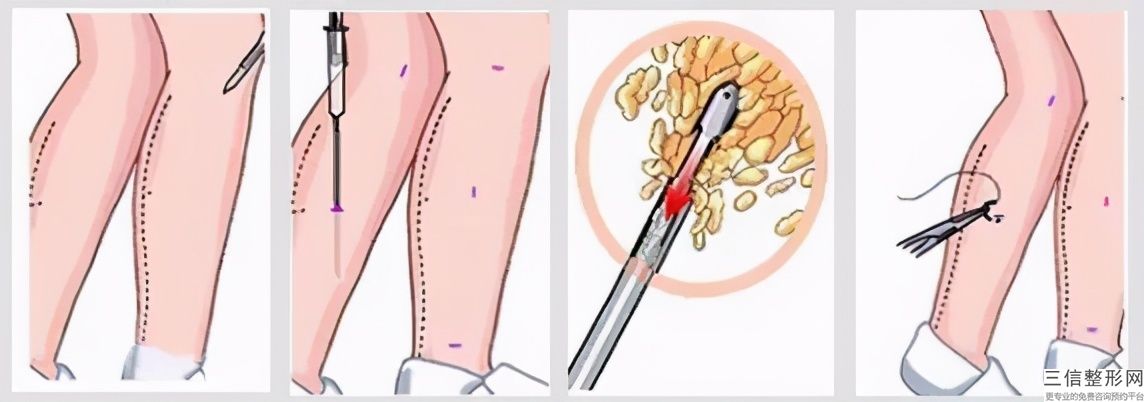 青島腰腹吸脂手術多少錢？腰椎吸脂的錢數與以下因素