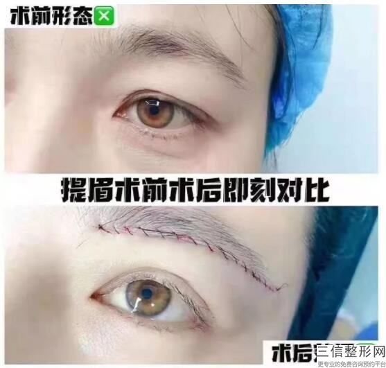 重慶去腫眼睛多少錢？去除眼袋的價格是多少