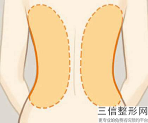 冷凍溶脂瘦肩膀多少錢,冷凍溶脂瘦臀部多少錢