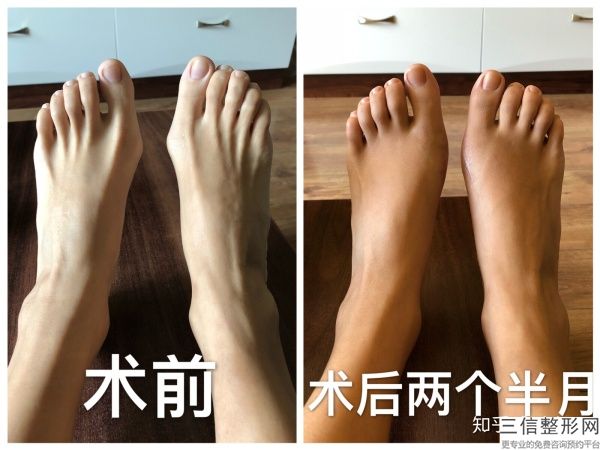 自體脂肪填充蘋果肌多少錢,自體脂肪填充蘋果肌大概價格