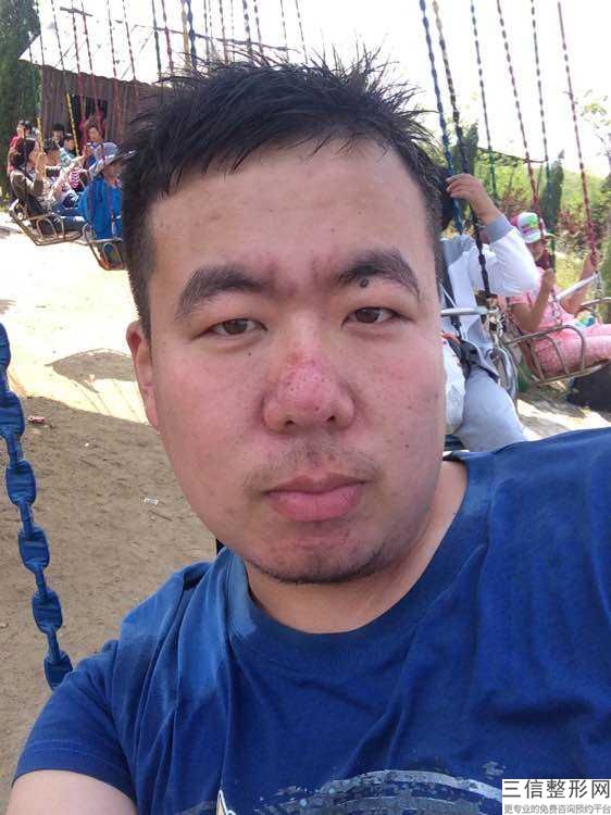 隆鼻失敗修復多少錢,深圳隆鼻失敗修復多少錢