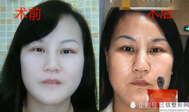 隆鼻失敗修復多少錢,深圳隆鼻失敗修復多少錢