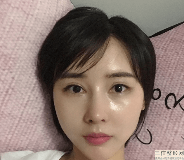 隆鼻失敗修復多少錢,深圳隆鼻失敗修復多少錢