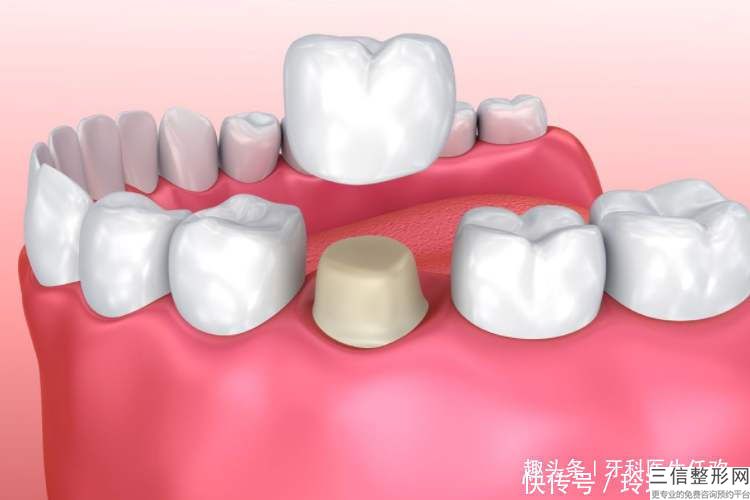 合金烤瓷牙多少錢,鈷鉻合金烤瓷牙多少錢一顆