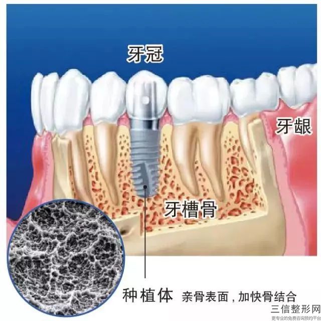 合金烤瓷牙多少錢,鈷鉻合金烤瓷牙多少錢一顆