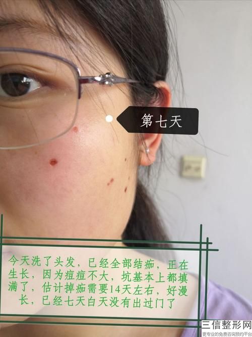玉門(mén)市西南去痘印價(jià)格表明細(xì)分享