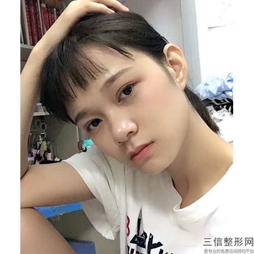 做眼瞼成形術的安全性如何有什么風險