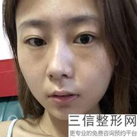 兔唇病能夠傳染給后輩嗎