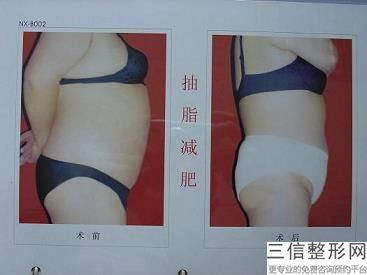 自體豐臀哪里做得好(豐臀自體脂肪)