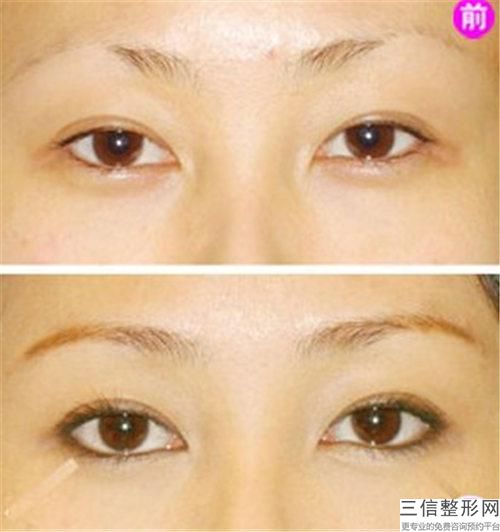 內(nèi)眥贅皮會(huì)影響雙眼皮嗎(有內(nèi)眥贅皮的雙眼皮更自然顯年輕)