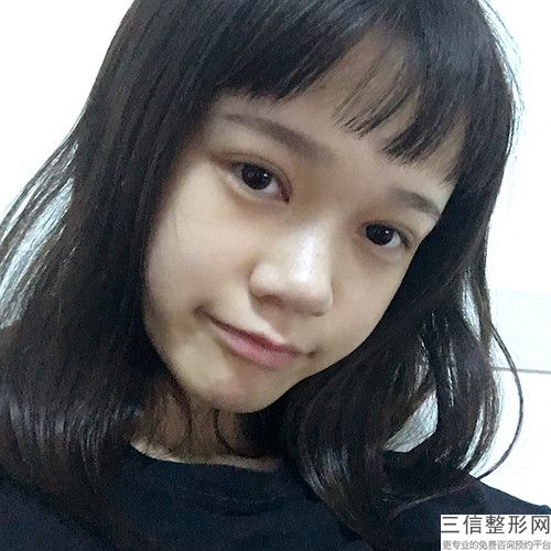 內眥贅皮怎么改善(眼皮內眥贅皮怎么改善)