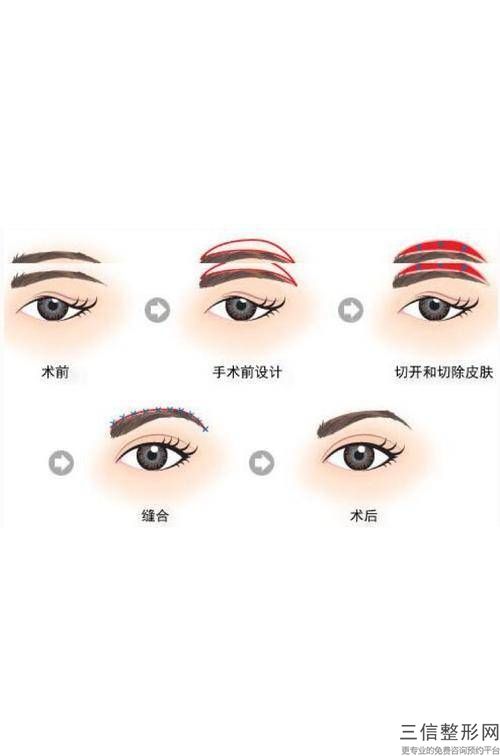 內眥贅皮怎么改善(眼皮內眥贅皮怎么改善)