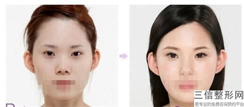 北京「大神教你」哪種人不合適割雙眼皮,—資訊網，揭秘爆料