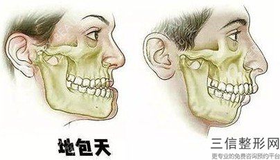 骨性地包天遺傳后代嗎-，骨性地包天會不會遺傳