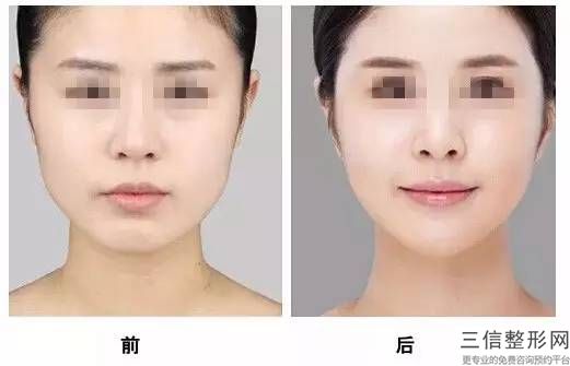 鷹鉤鼻能做鼻子整形嗎，鷹鉤鼻整形效果