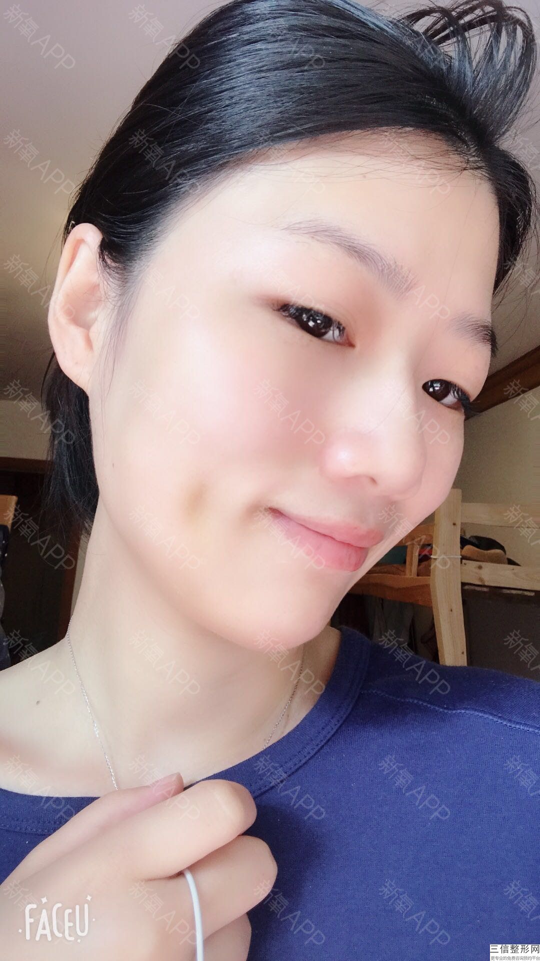 面部年輕化門診主要做哪些項(xiàng)目，什么叫面部年輕化手術(shù)