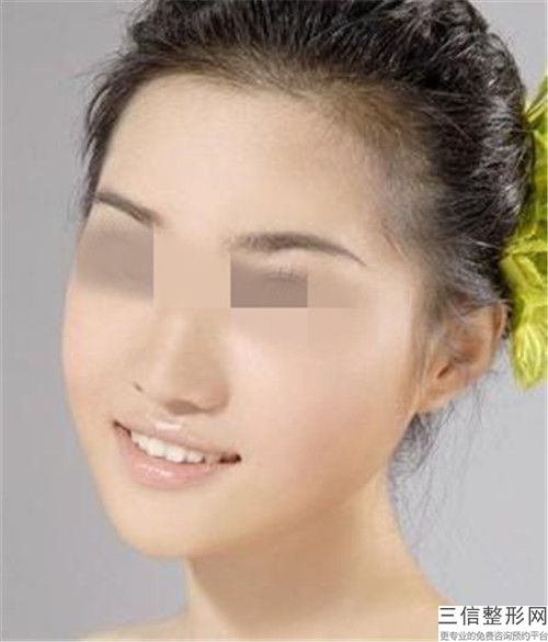 顴骨增高術是大手術嗎，高顴骨怎么整