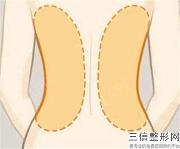 自體脂肪填充下巴缺點，自體脂肪下巴和假體下巴效果