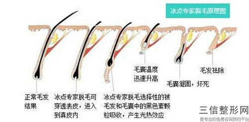 2023年深圳市絡腮胡激光脫毛整形三甲醫院有哪些(深圳市絡腮胡激光脫毛整形醫院)