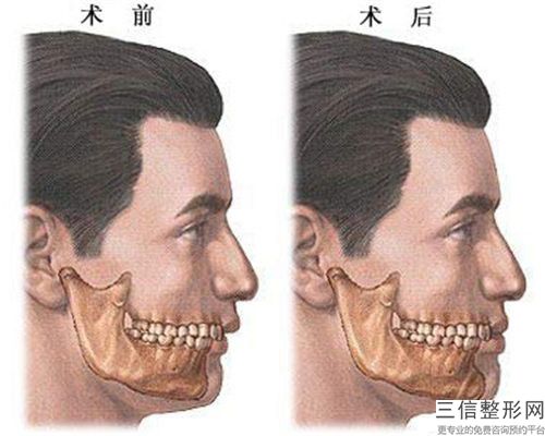 安法硅膠墊下巴整形之后需要怎么護理