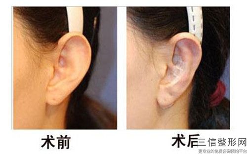 濮陽(yáng)市先天性無(wú)耳廓醫(yī)院排行榜前十佳人氣機(jī)構(gòu)（濮陽(yáng)美婷醫(yī)療美容診所實(shí)力不相上下_）