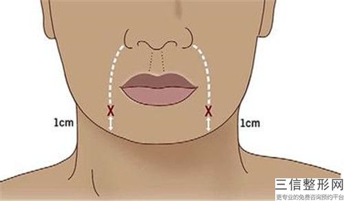 長沙市膠原蛋白去除抬頭紋醫生排行top10是哪個-孫楊醫生技術優勢專業解答