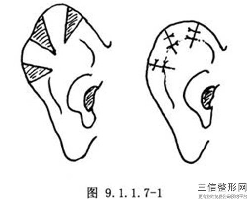 湖南省耳朵外輪廓有個小缺口項目價格表2023曝光-湖南省耳朵外輪廓有個小缺口手術需要什么費用