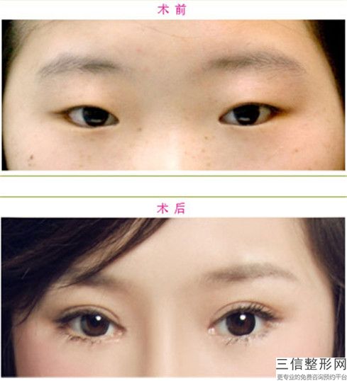 漳州眼瞼內(nèi)翻矯正的費(fèi)用你了解多少,漳州眼瞼內(nèi)翻矯正價(jià)位在多少