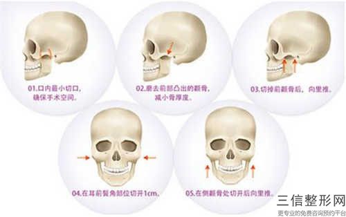 榆林顴骨顴弓手術手術一般要多少價格