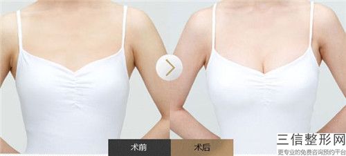 白山矯正乳房下垂手術大概多少錢左右