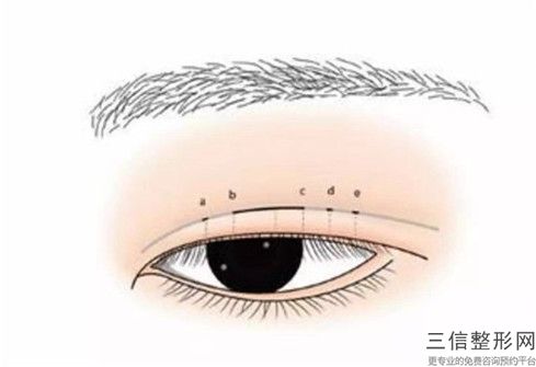 孫慧整形醫生眼皮提拉手術技術好嗎醫生口碑簡介、手術案例、口碑