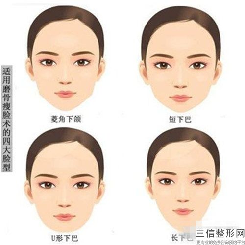 深圳市雙下巴女孩醫院哪家技術比較好-雙下巴女孩整容術費用