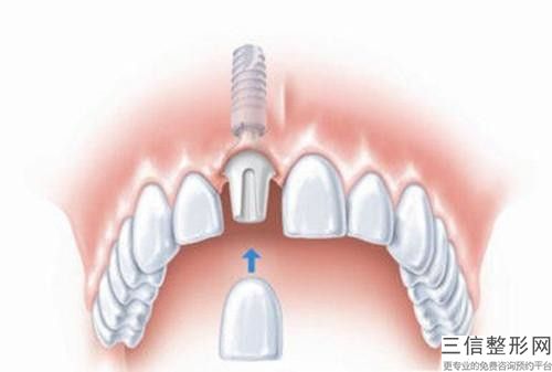 滁州市種植牙貴金屬牙冠醫院上榜清單top10強已就位（滁州市種植牙貴金屬牙冠口腔醫院技術優勢介紹）