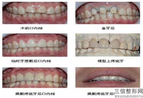 蕪湖裝固定橋牙齒大概需要費用是多少錢啊