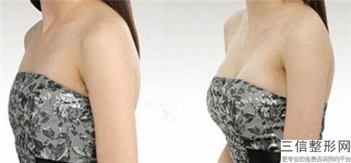 國內乳房上提手術整型醫院：乳房上提手術醫院前50比較正規