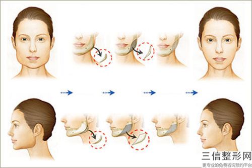 山東省脂肪豐下巴手術(shù)醫(yī)院推薦：脂肪豐下巴手術(shù)醫(yī)院20強(qiáng)權(quán)威一覽