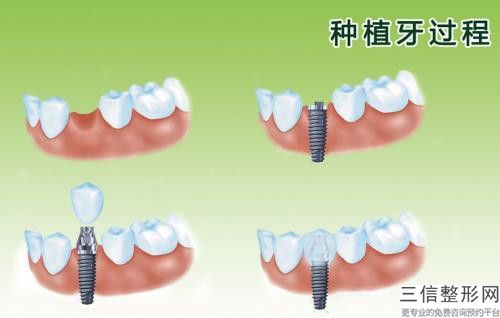 無錫全口牙齒開髓洞型手術的價格貴不貴呢