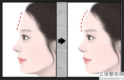 天津締美醫療美容額頭提拉手術怎么樣項目特色優勢