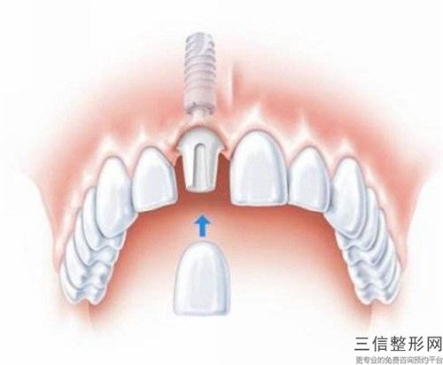 重慶武隆健美口腔醫院整牙嵌體安全嗎,會不會出現什么副作用