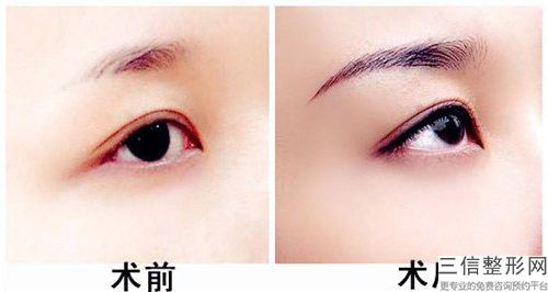 合肥斑巢堂港式眉毛術一般能維持多長時間